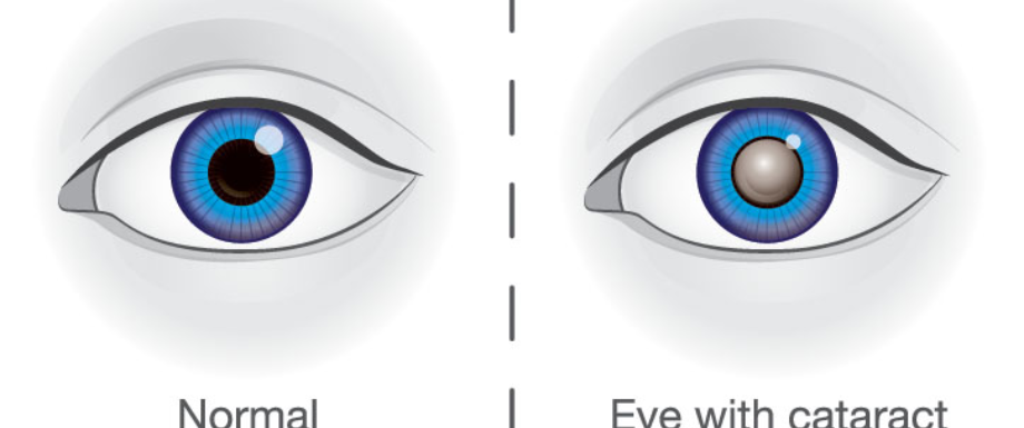 	
Diabetes and Eyes – Diabetic Cataract